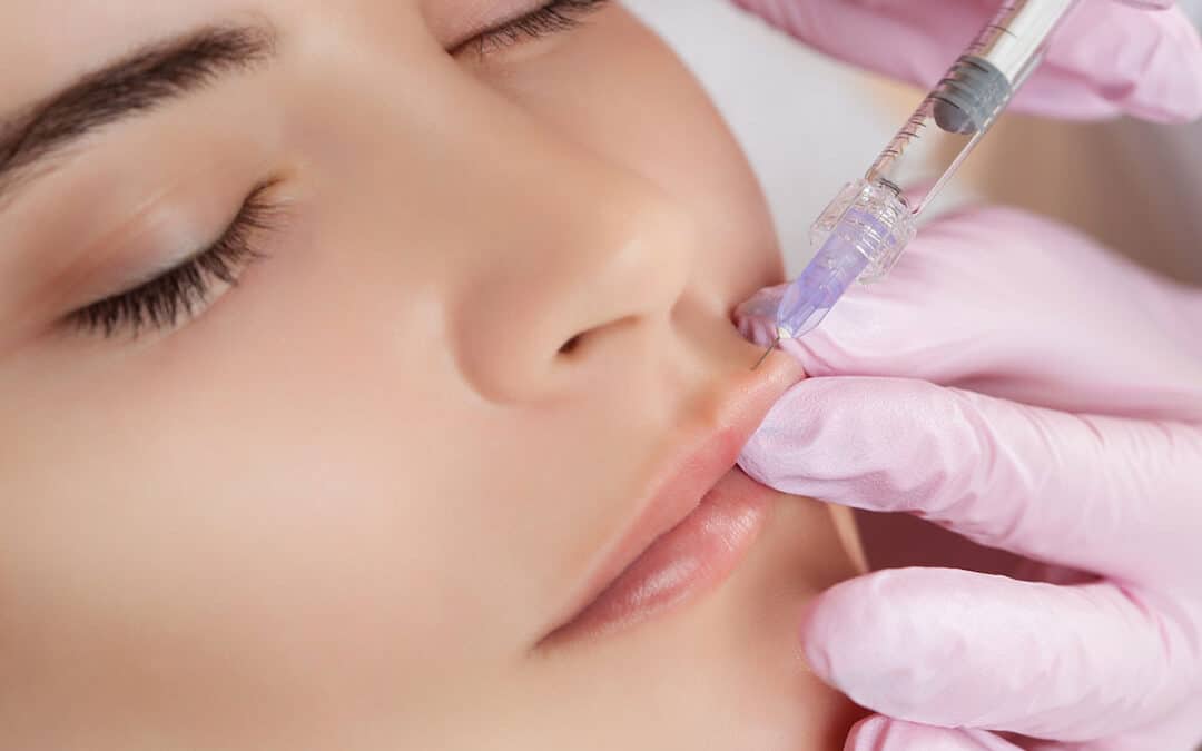5 Benefits of Lip Filler Services in San Diego with Katalyst Wellness
