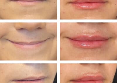 Lip Enhancement before and after san diego 1024x1024 1