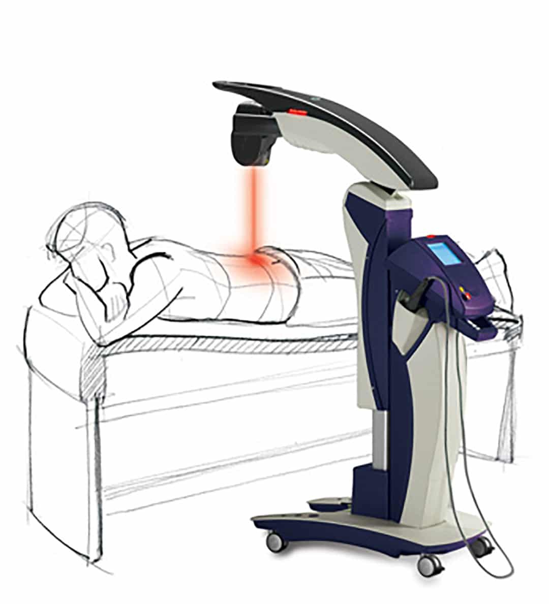 MLS Laser Therapy San Diego