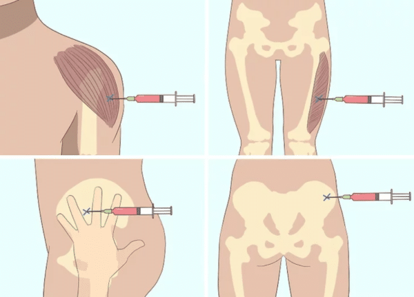 How to Inject B12