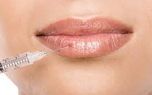 Lip Injections San Diego — Everything You Need To Know