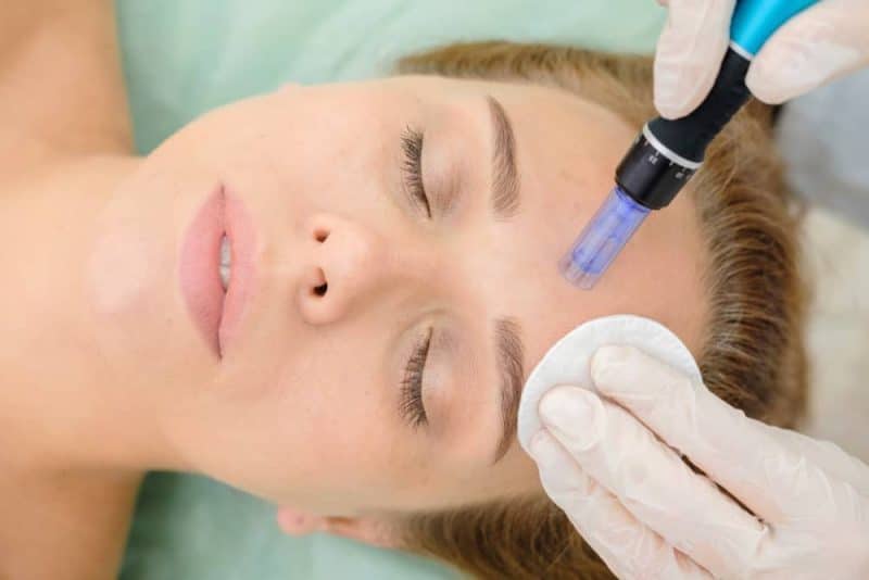 Microneedling for acne