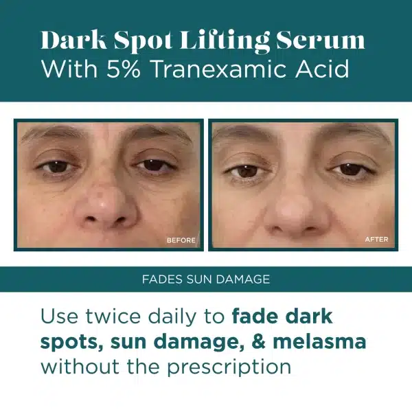 Dark Spot Treatment