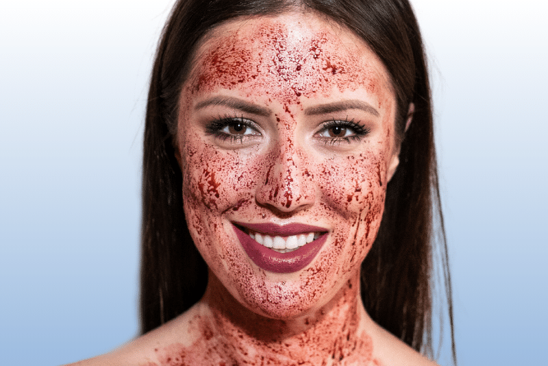 Girl with blood on face from PRP facial