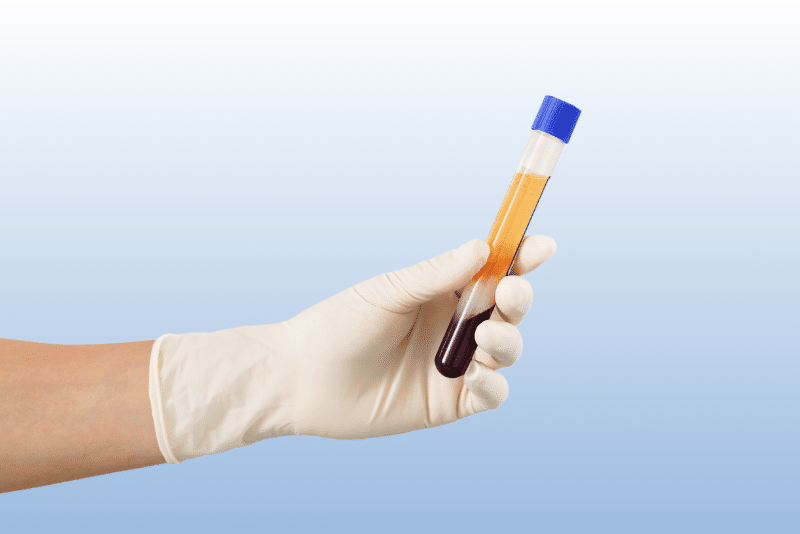 Syringe with Blood for PRP Facial